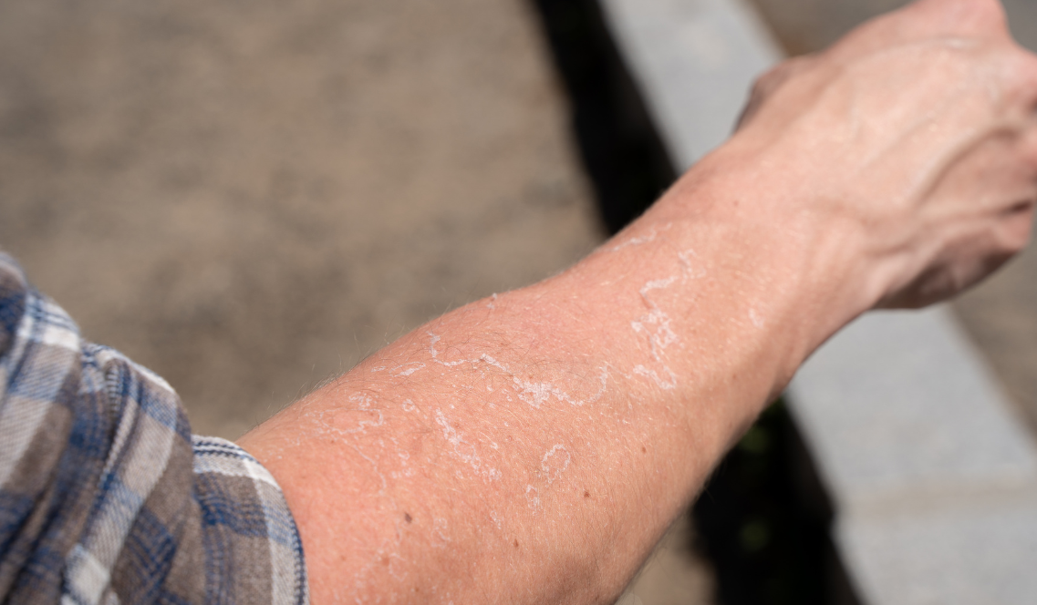 Sole e secchezza su corpo e capelli: rimedi Sole e secchezza su corpo e capelli: rimedi