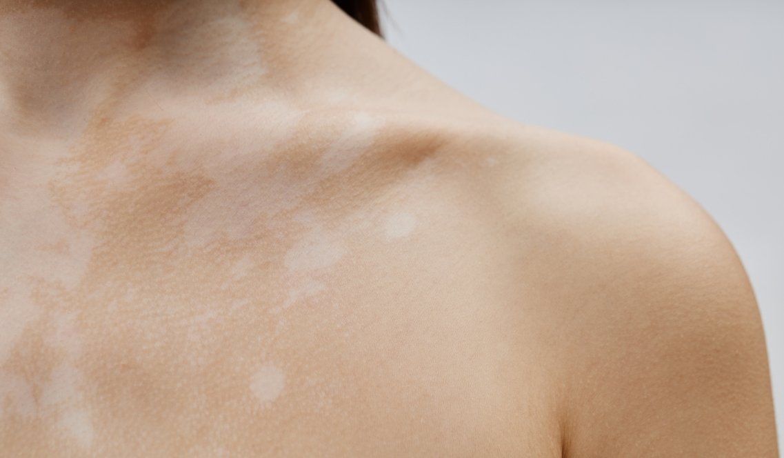 Micosi non solo ai piedi: come riconoscere e trattare la Pityriasis Versicolor