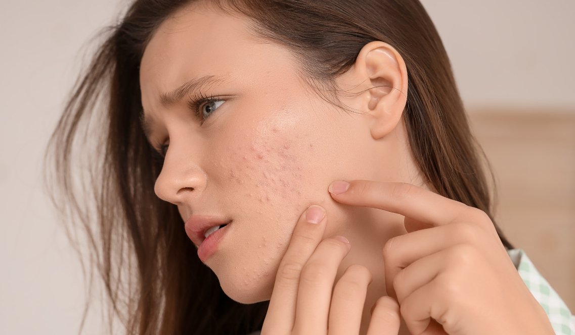 Sudore e acne: come purificare la pelle senza seccarla sotto il sole