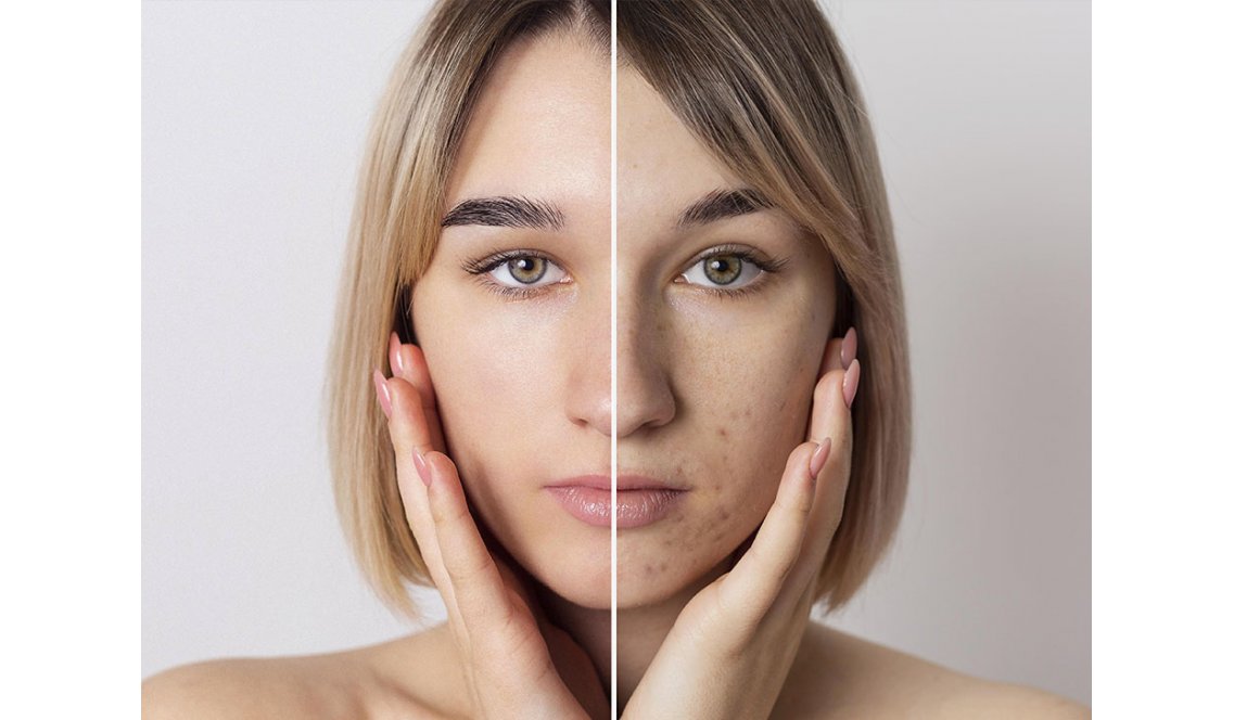 Cicatrici da acne: come eliminarle e non solo